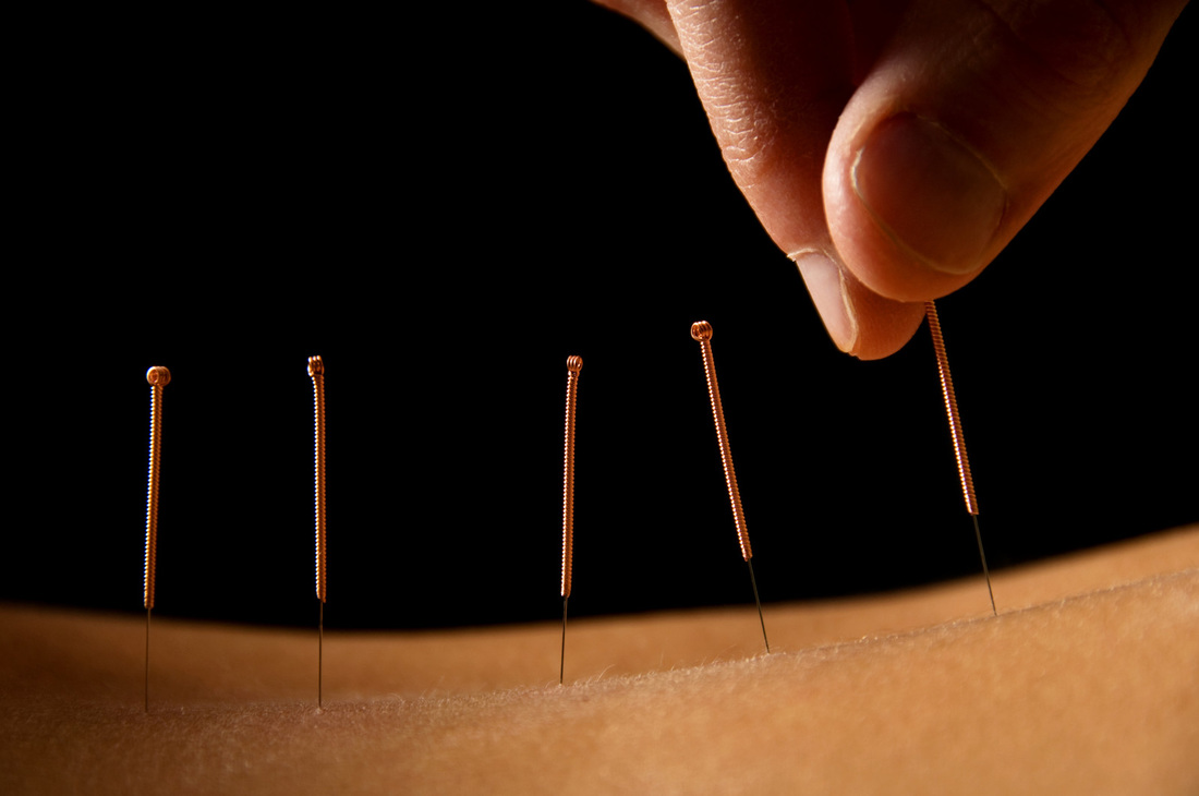 Acupuncture in London, Ontario