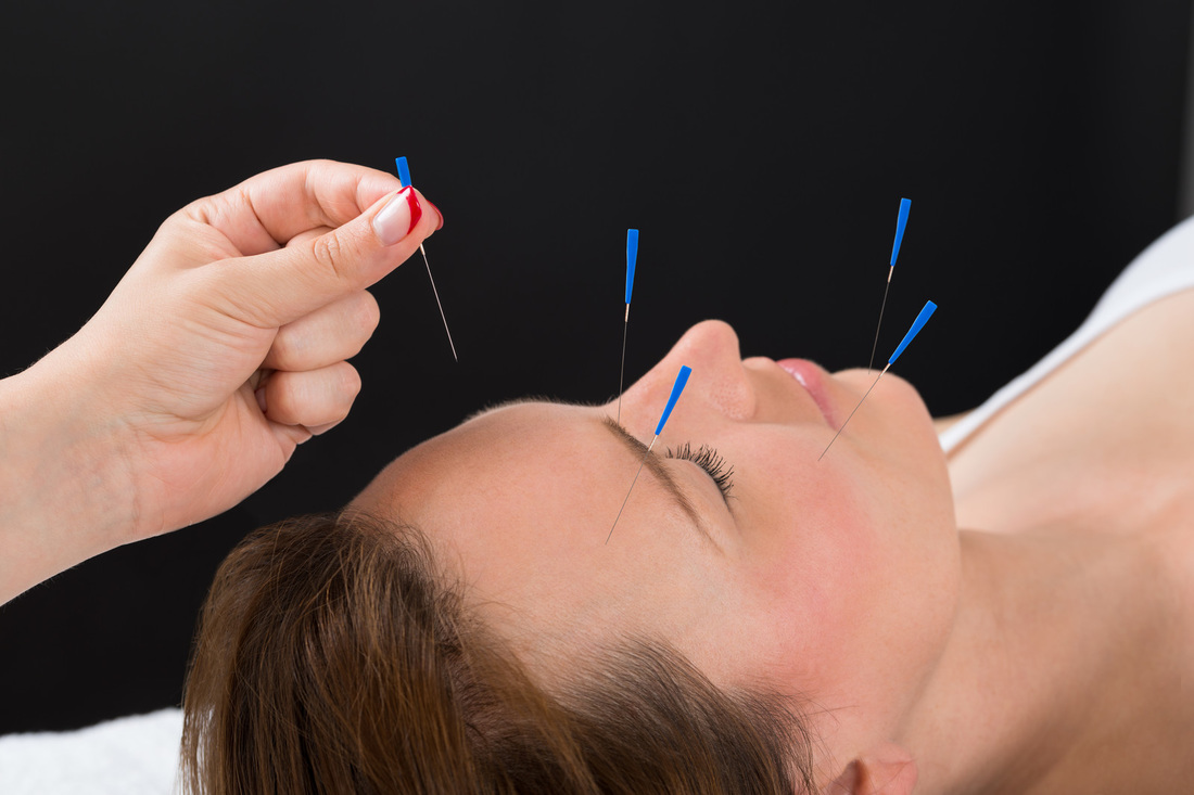 Cosmetic Accupuncture in London,Ontario